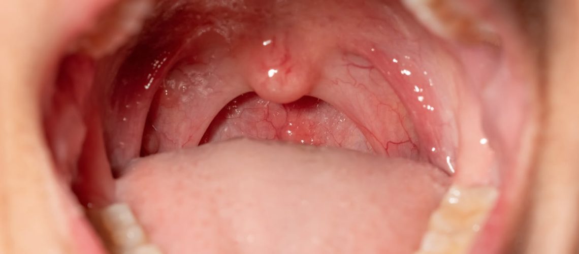 Connaissez-vous le syndrome de la fellation vigoureuse ?